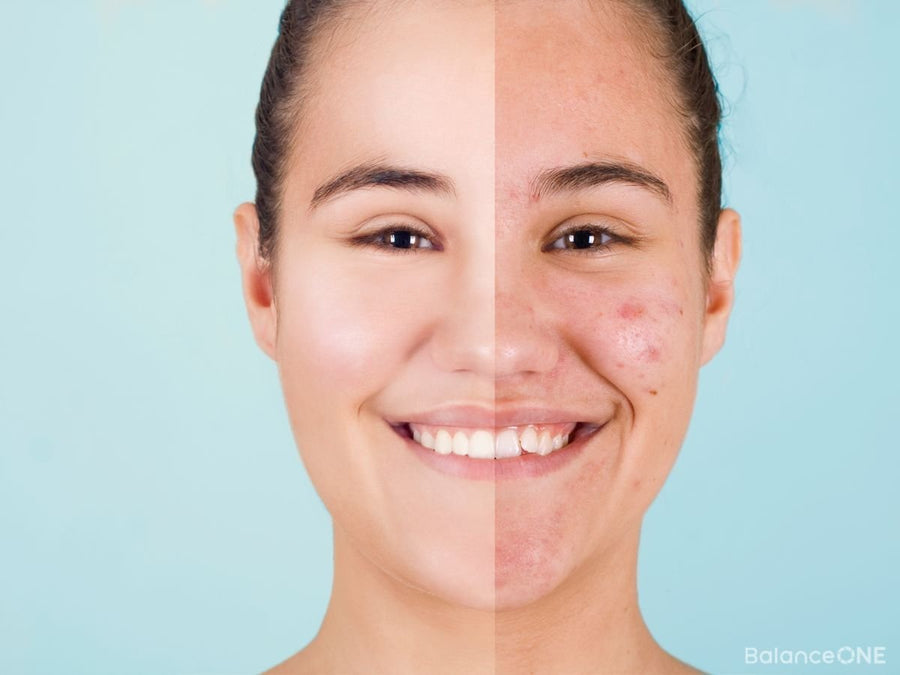 How Fixing Your Gut Can Help With Your Acne – Balance ONE